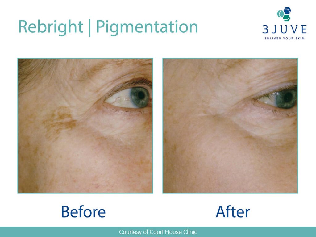 Treating Pigmentation with Laser & IPL • Lynton Lasers