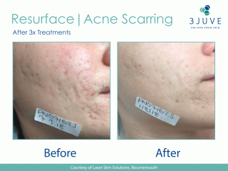 3JUVE ResurFACE Acne Scarring Treatment Before and After Reslult After 3 Treatments
