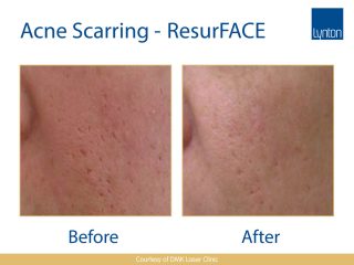 Lynton Lasers LUMINA Acne Scarring Treatment Before and After Result on Face