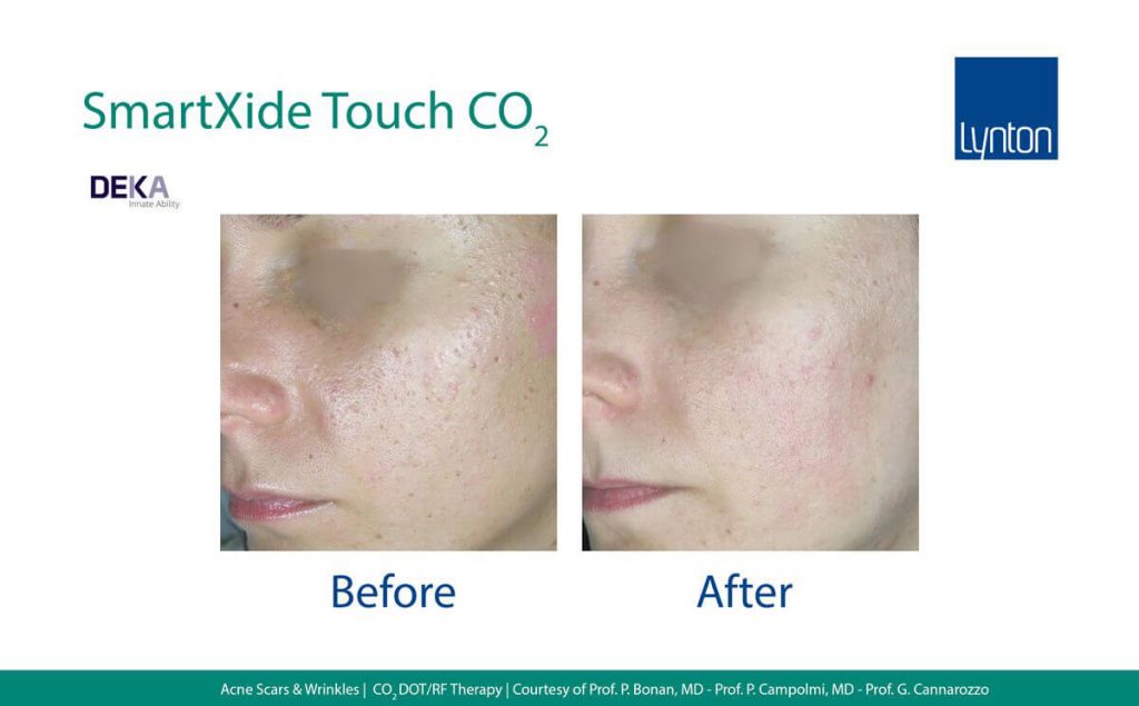 Laser Treatment for Scars Guide • Lynton Lasers