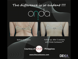 ONDA Coolwaves fat reduction before and after result on womans back after 2 treatments