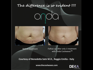 ONDA Coolwaves skin tightening before and after result after 1 treatment on womans stomach