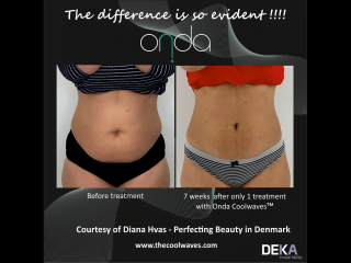 ONDA Coolwaves fat reduction before and after result on womans stomach after 1 treatment