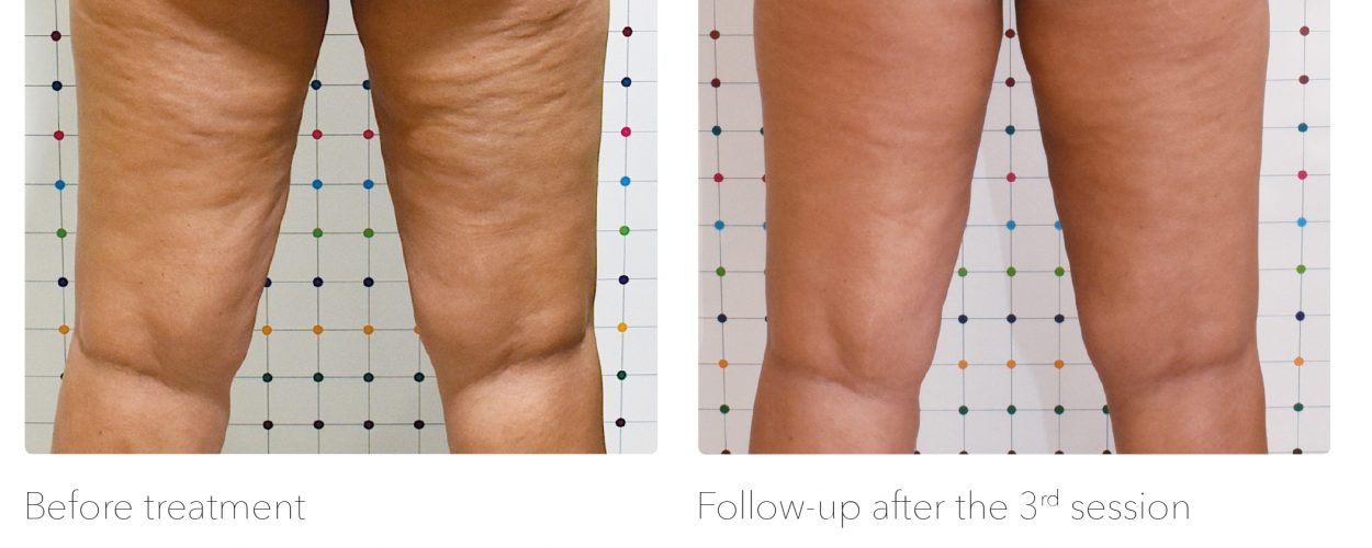 Cellulite treatment before and after