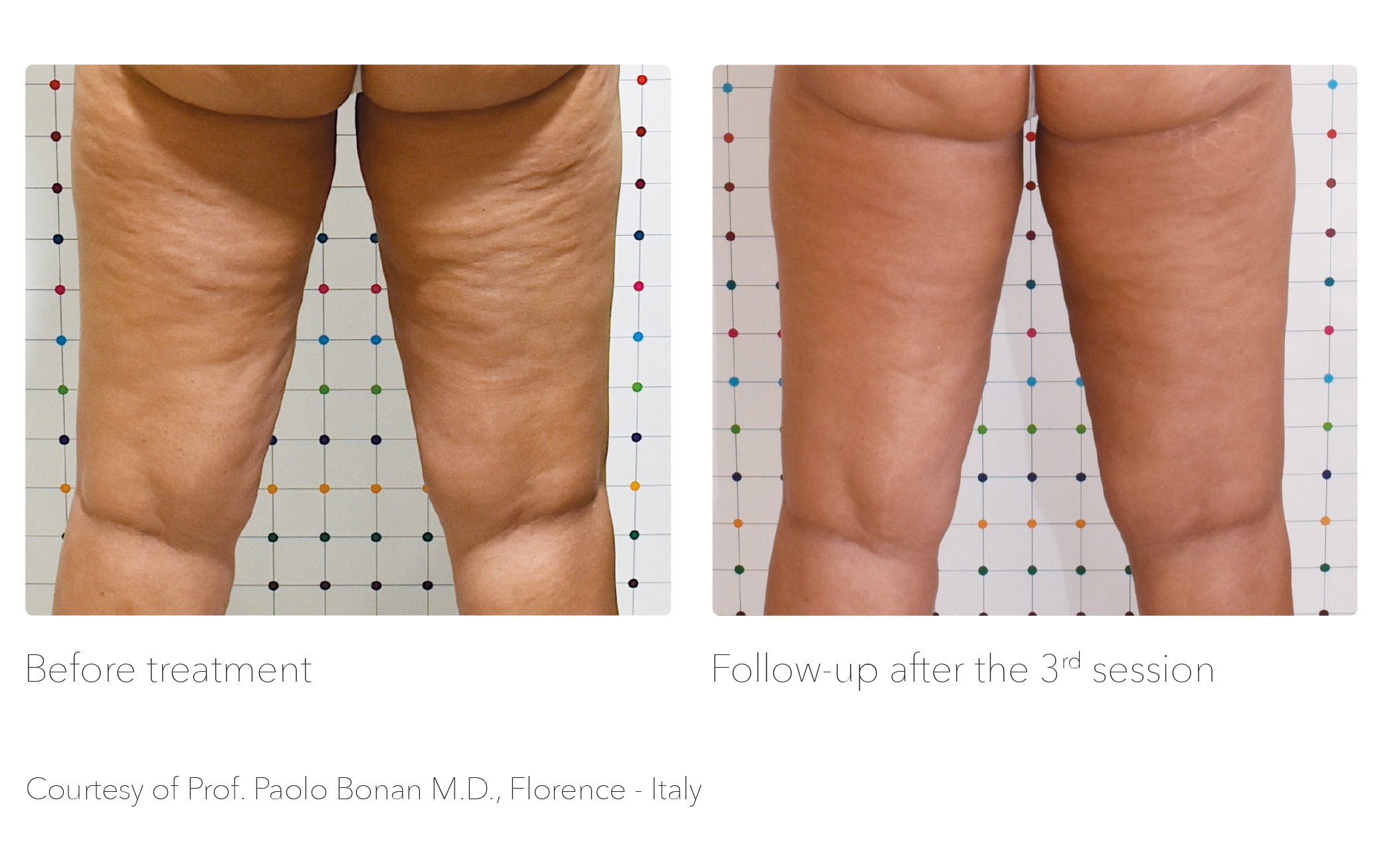 All About Cellulite Causes: Why Do I Have Cellulite?