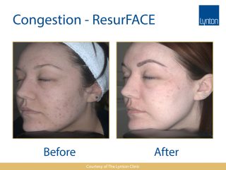 Lynton Lasers LUMINA ResurFace Treatment Before and After Result on Woman Face