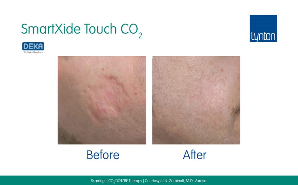 Laser Treatment for Scars Guide • Lynton Lasers