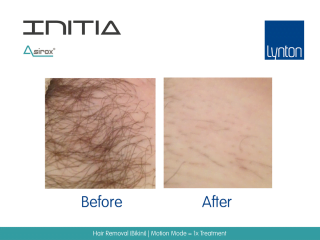 INITIA Diode Laser Hair Removal Before and After Result from One Treatment