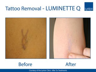 Lynton Lasers Luminette Q Tattoo Removal Laser Before and After Result on Arm
