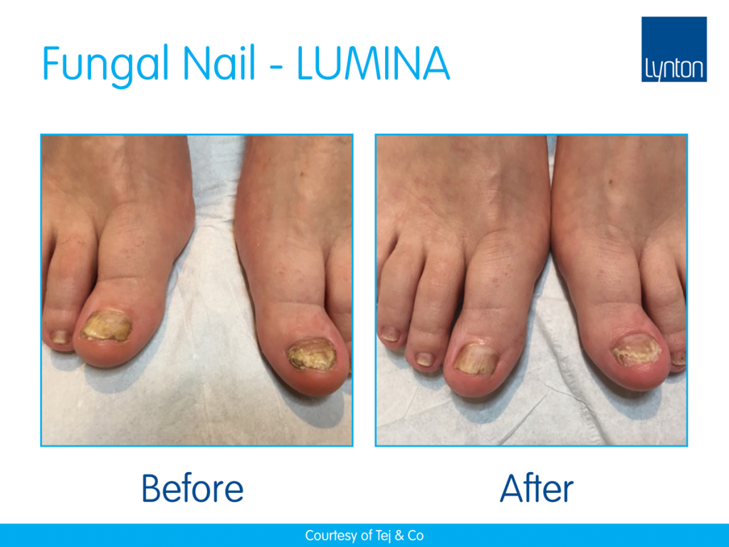 Laser Treatment Machines for Nail Fungus or Fungal Nail • Lynton Lasers
