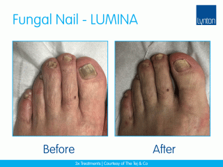 Lynton Lasers LUMINA Fungal Nail Treatment Before and After Result