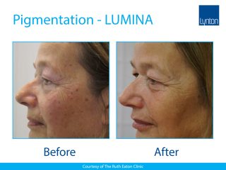 Lynton Lasers LUMINA Pigmentation Treatment Before and After Result