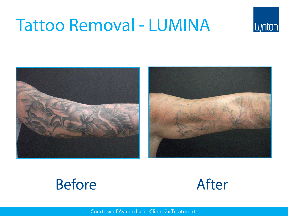 Tattoo Removal Lasers • Tattoo Removal Machines • Lynton Lasers
