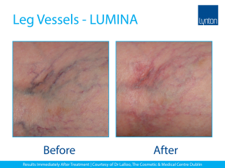 Lynton Lasers LUMINA Vascular Treatment Before and After Result