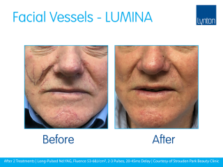 Lynton Lasers LUMINA Facial Veins Before and After Treatment Result on the Face