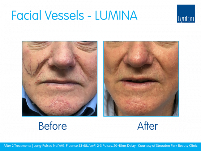 LUMINA • Professional Laser and IPL Machine • Lynton Lasers