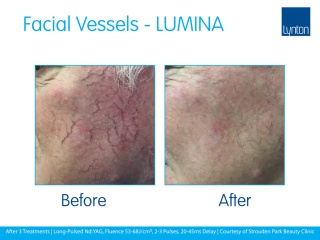 Lynton Lasers LUMINA Facial Veins Before and After Treatment Result on the Face