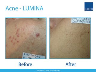 Lynton Lasers LUMINA Acne Treatment Before and After Result