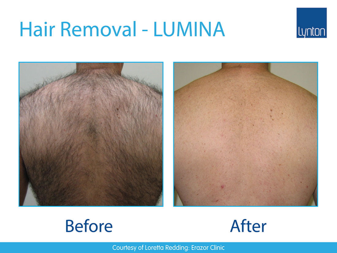 Professional Hair Removal Machines Laser & IPL • Lynton Lasers