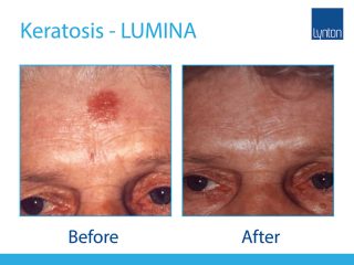 Lynton Lasers LUMINA Keratosis Treatment Before and After Result