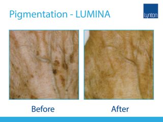 LUMINA Pigmentation Treatment Before and After Result on Hands