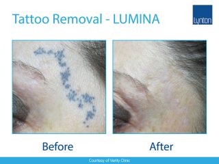 Lynton Lasers LUMINA Tattoo Removal Treatment Before and After Result on Face