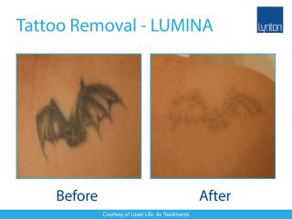 LUMINA Laser Tattoo Removal Before and After Result