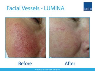 Lynton Lasers LUMINA Thread Veins Treatment Before and After Result On Face