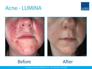 Lynton Lasers LUMINA Acne Treatment Before and After Result on Face
