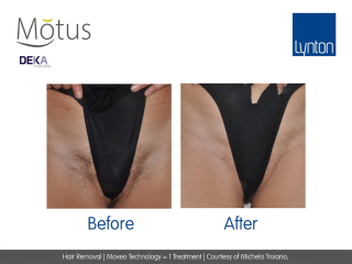 Motus AY Laser Hair Removal with Moveo Technology Before and After One Treatment on Bikini Line