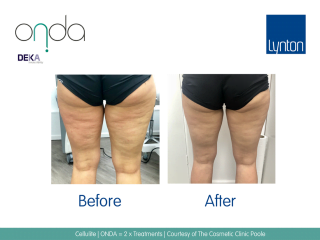 ONDA Coolwaves Cellulite Treatment Before and After Result on Womans Legs After 2 Treatments