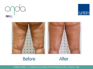 ONDA Coolwaves Cellulite Treatment Before and After Result on Womans Legs After 3 Treatments