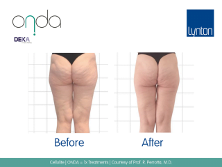 ONDA Coolwaves Cellulite Treatment Before and After Result on Womans Legs After 5 Treatments