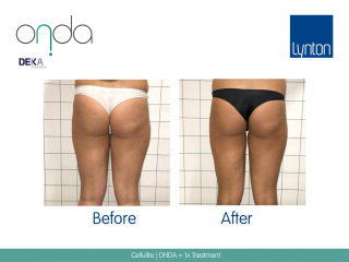 ONDA Coolwaves Cellulite Treatment Before and After Result on Womans Legs and Bum After 1 Treatments