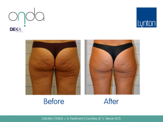 ONDA Coolwaves Before and After Results of Cellulite Treatment on a Womans Bum After One Treatment