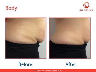 Fat Removal - before and after