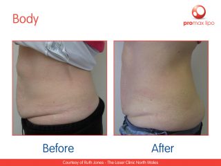 non surgical Fat removal