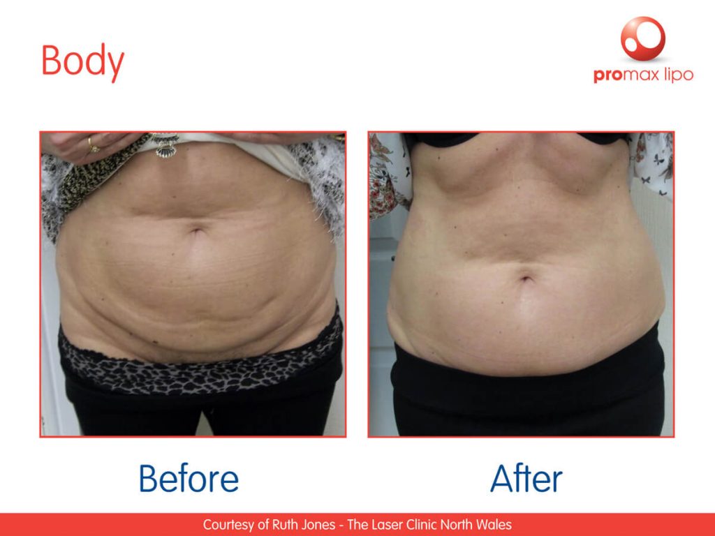 ProMax LIPO NonSurgical Liposuction Machine • Lynton Lasers