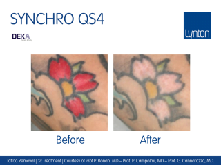 Synchro QS4 Laser Tattoo Remova Machine Before and After Result After 3 Treatments