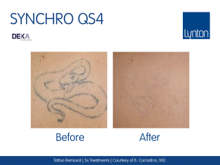 Synchro QS4 Laser Tattoo Removal Before and After Result After 3 Treatments