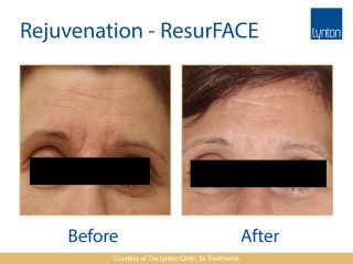 Lynton Lasers LUMINA Skin Rejuvenation Before and After Result on Woman Face