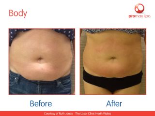 non surgical Fat removal before and after