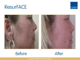 Lynton Lasers LUMINA Scar Treatment Before and After Result on Woman Face