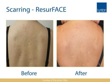 Lynton Lasers LUMINA Scar Treatment Before and After Result on Woman Back