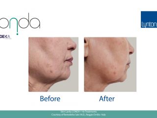 Skin Laxity Before and After with Onda