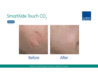 SmartXide Touch Co2 Acne Scarriing Before and After Result on Face