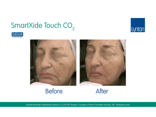 SmartXide Touch Co2 Benign Pigment Before and After Result on Womans Face