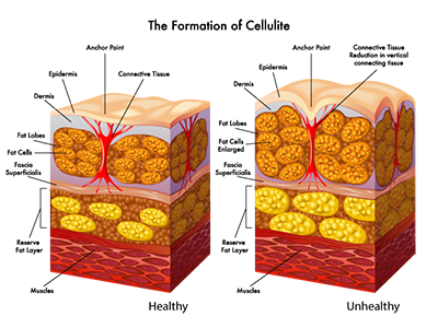 Cellulite Formation