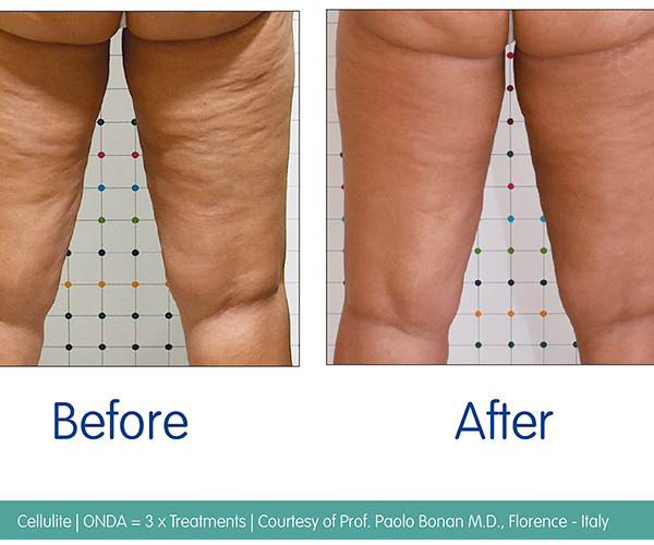 Microwaves in the treatment of cellulite • Lynton Lasers