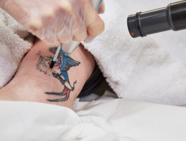 Tattoo Removal Treatment Close Up